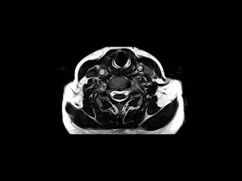 S-scan - 3D Hyce Axial Cervical
