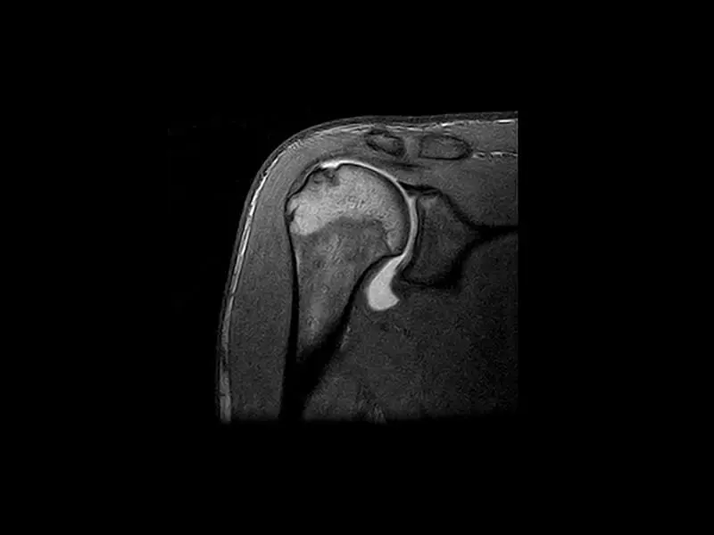 S-scan - 3D SHARC Arto Coronal Shoulder