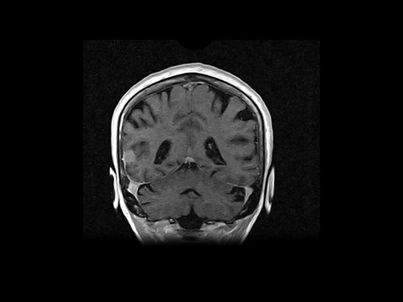 S-scan - 3D SST1 Coronal Head