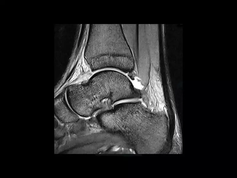 S-scan - Ankle eXP 150 resolution 0.43x0.625