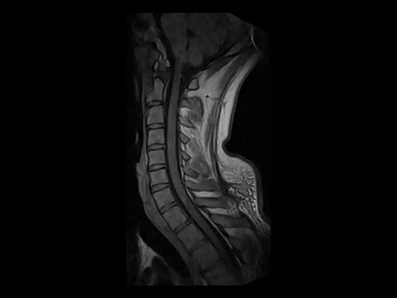 S-scan - Cervical Spine Echo Sagittal Exp
