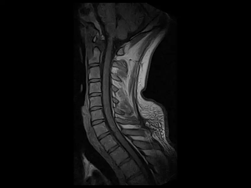 S-scan - Cervical Spine Echo Sagittal No exp 4.26
