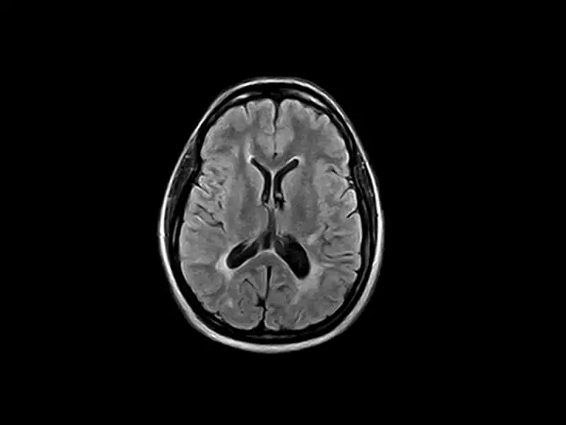 S-scan - FLAIR Axial Head