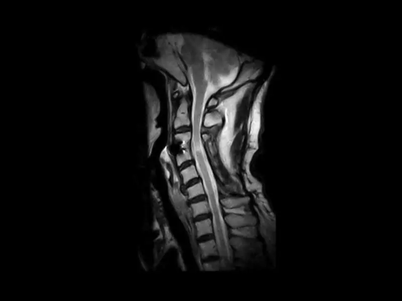 S-scan - FSE T2 Sagittal Cervical