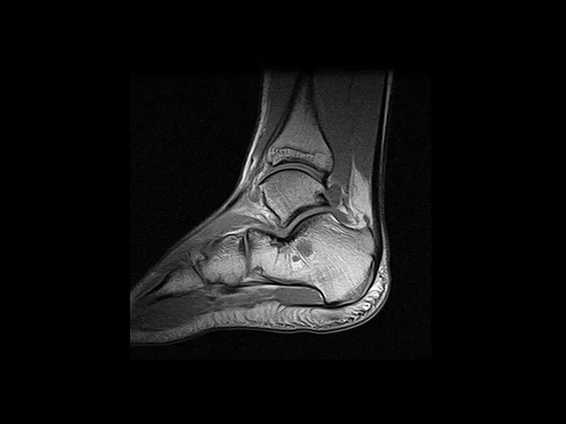 S-scan - SE T1 sag ankle