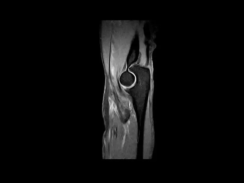 S-scan - SPED Fat Suppression Sagittal Elbow