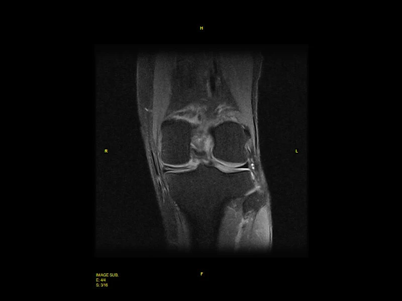 S-scan - SPED cor knee