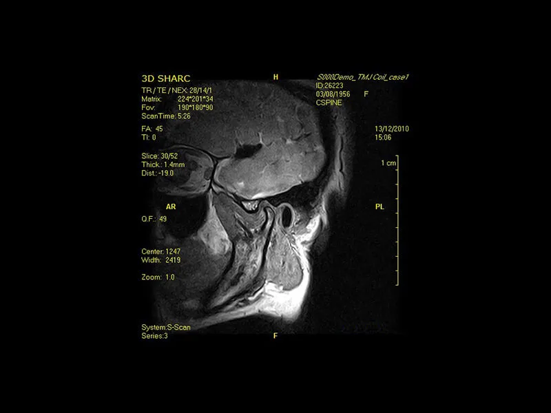 S-scan - TMJ 3D SHARC sagittal
