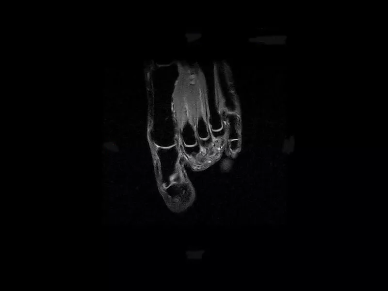 S-scan - XBONE Coronal Foot