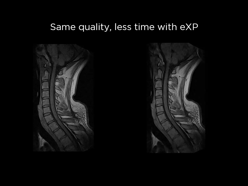 S-scan - eXP Cervical